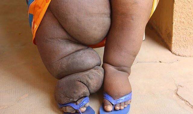 Les maladies tropicales négligées