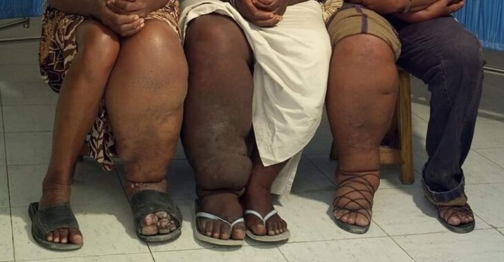 Comment lutter contre l'éléphantiasis