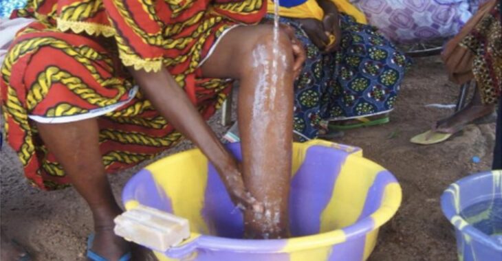 Filariose lymphatique, une maladie qui fait souffrir en silence