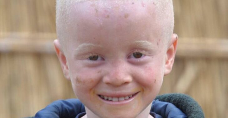 Burkina Faso : la souffrance des personnes vivant avec l’albinisme