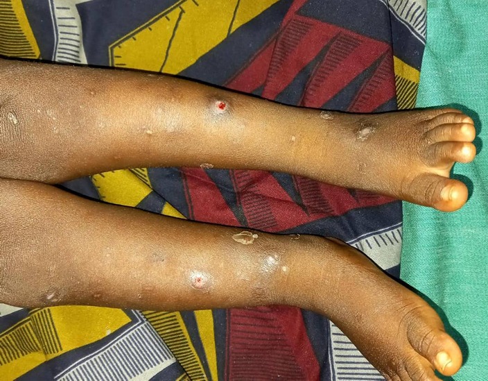 Plaies saisonnières, ce mal intraitable des périodes de pluies