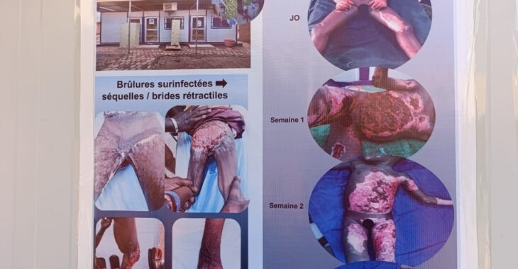 Des difficultés dans la prise en charge des brûlés  à la Pédiatrie Charles De Gaulle