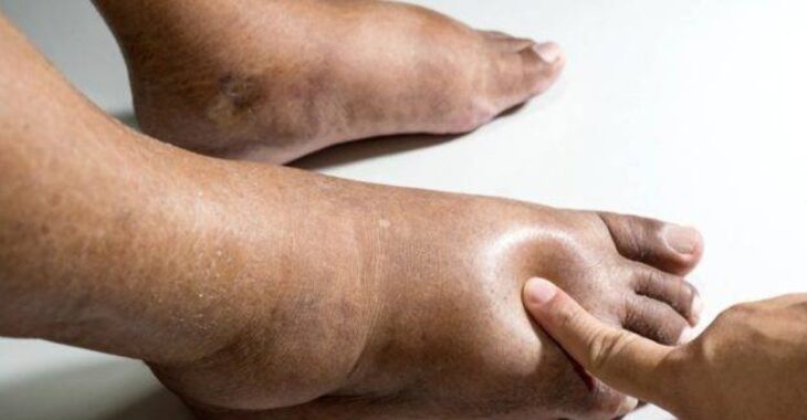Des pieds enflés, un signal à ne pas ignorer