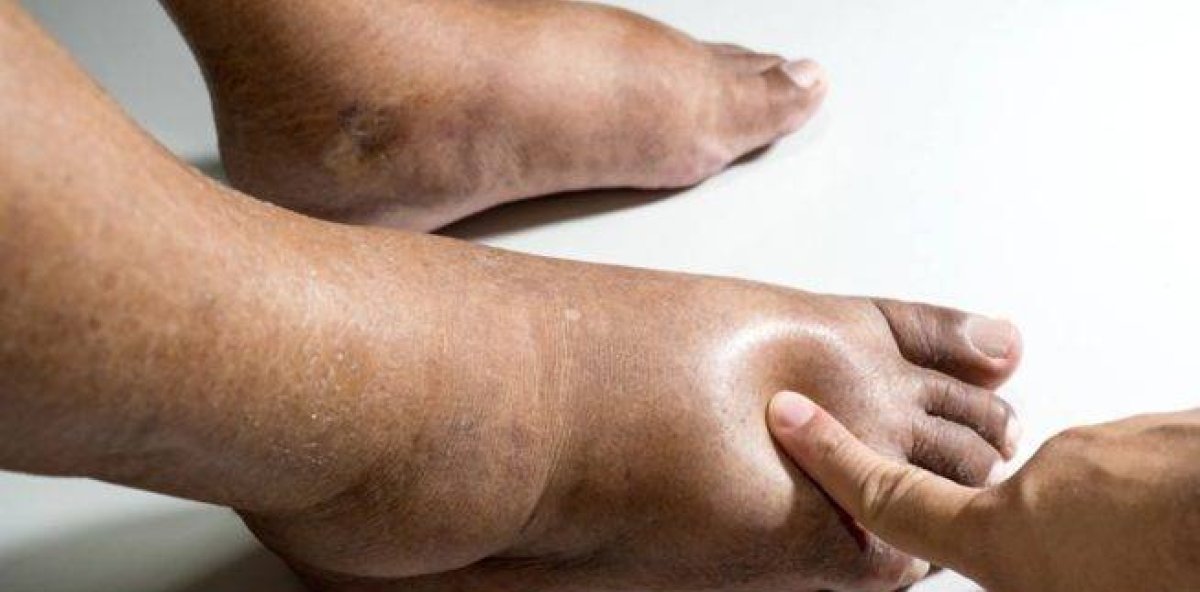 Des pieds enflés, un signal à ne pas ignorer