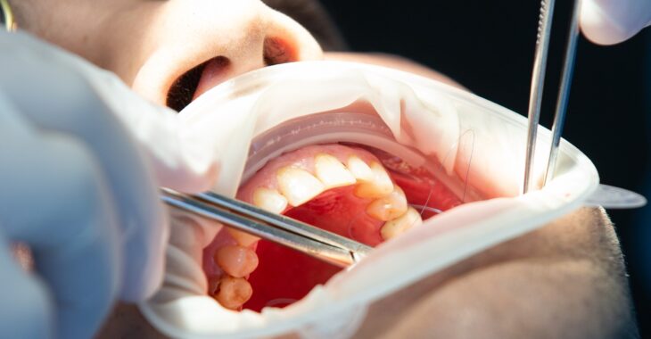 Maladies bucco-dentaires : les bons réflexes pour protéger ses dents et éviter les complications